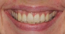 After Invisalign – corrected tooth angulation and improved alignment