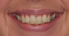 Before Invisalign – proclined and retroclined teeth