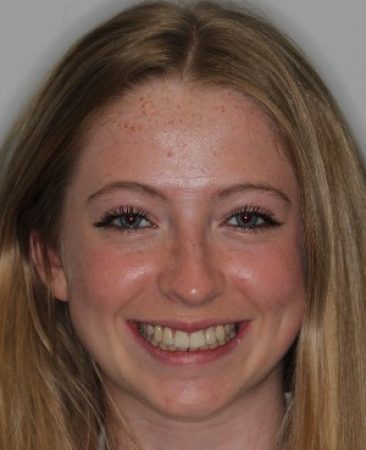After Invisalign Teen treatment – teenage patient with aligned smile in Fareham