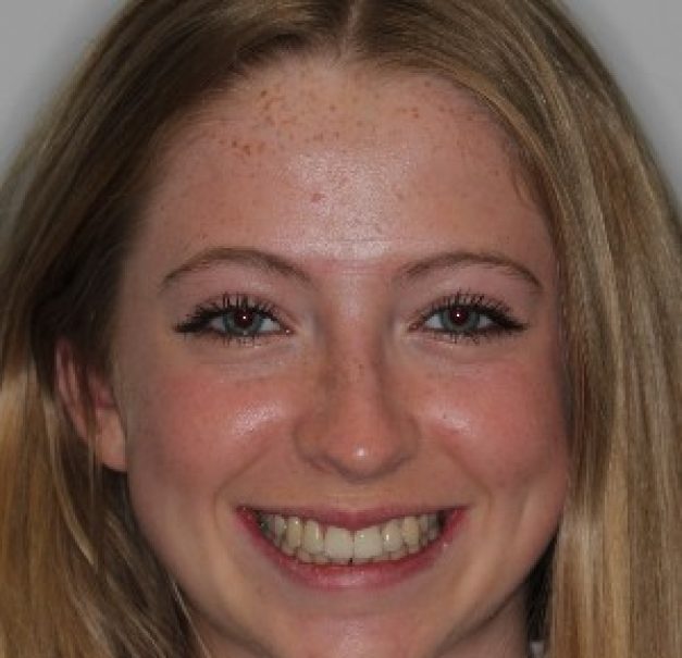 After Invisalign Teen treatment – teenage patient with aligned smile in Fareham