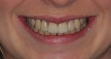 After Invisalign Teen – corrected alignment and improved symmetry