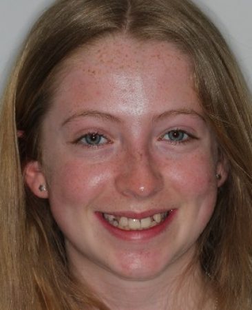 Before Invisalign Teen treatment – teenage patient with hidden upper teeth in Fareham