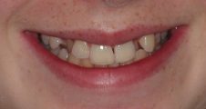 Before Invisalign Teen – hidden and misaligned upper teeth