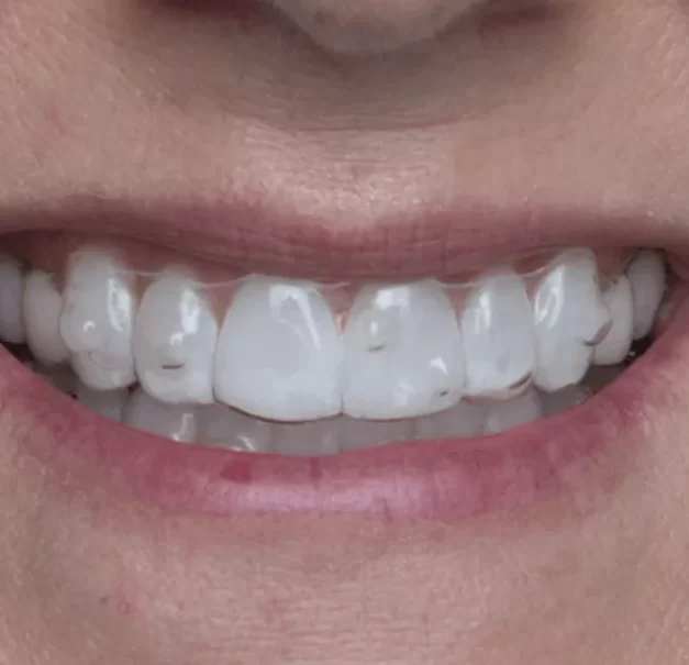 spark aligners on adult patients