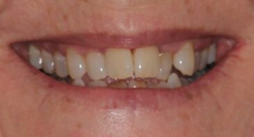 Adult Crooked teeth before Invisalign clear aligners