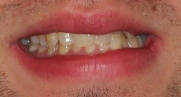 Close up view of smile of young adult with crooked teeth before Invisalign