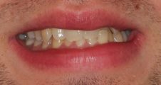 Before Invisalign – crowded and misaligned front teeth