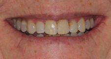 After Invisalign treatment - broader smile and straight teeth in fareham