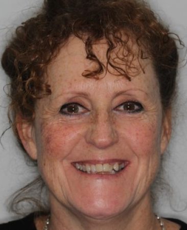 Before Invisalign treatment – adult patient with narrow smile and upper crowding in Fareham