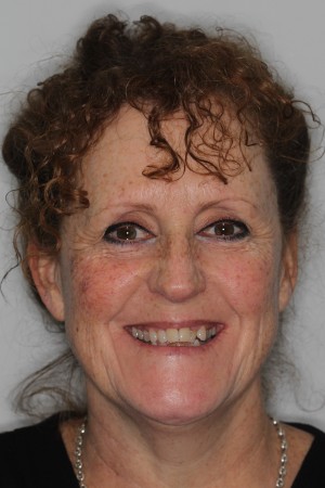 Before Invisalign treatment – adult patient with narrow smile and upper crowding in Fareham