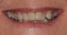 Before Invisalign treatment – adult patient with narrow smile and crooked teeth in fareham