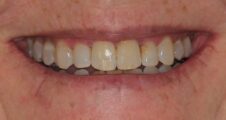 Adult Straight teeth, broader smile after Invisalign