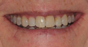 Adult Straight teeth, broader smile after Invisalign