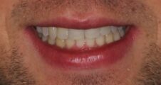 Young adult after Invisalign, straight teeth, composite bonding