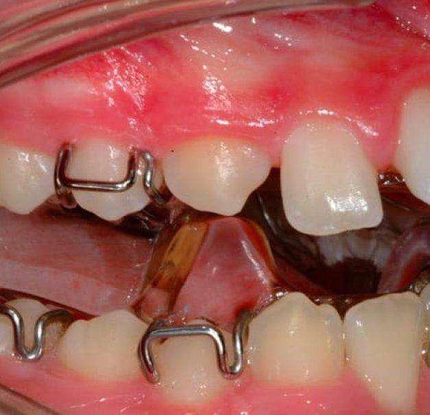 functional appliance