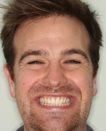 adult patient after damon braces treatment correcting severe crowding in fareham