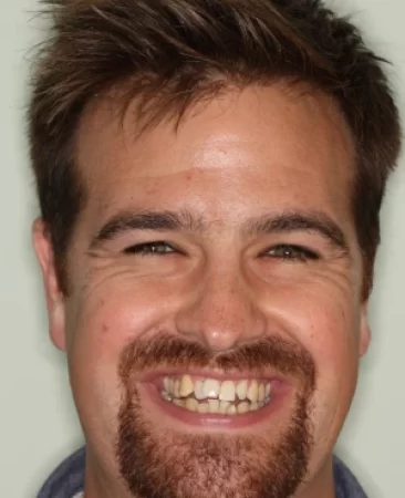 adult patient before damon braces treatment for severe crowding requiring extractions in fareham