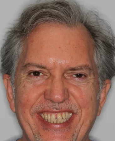 adult patient before damon braces treatment with spaced teeth and uneven tooth edges in fareham