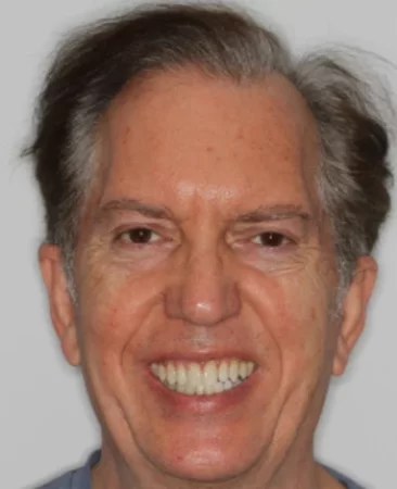 adult patient after damon braces treatment and whitening correcting spaced teeth in fareham