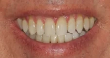 adult patient after damon braces treatment and whitening correcting spaced teeth in fareham