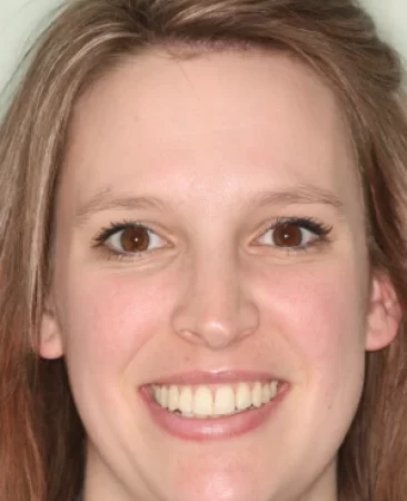 Adult fixed braces crowded teeth after treatment with straightened smile face Fareham