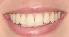 Adult fixed braces crowded teeth after treatment with straightened smile Fareham