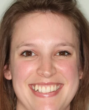 Adult fixed braces crowded teeth before treatment face Fareham