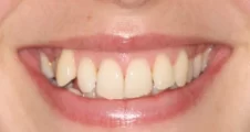 Adult fixed braces crowded teeth before treatment smile Fareham