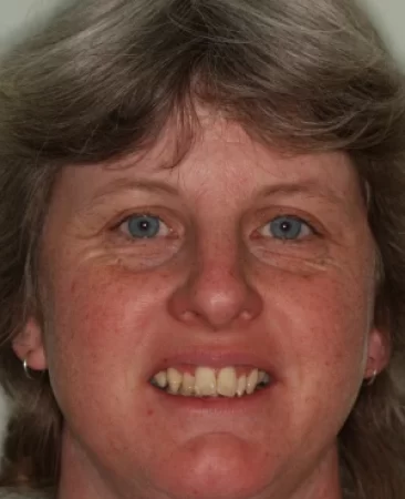 adult fixed braces gaps between teeth before treatment face Fareham