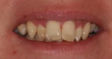 Adult fixed braces sticking out teeth after treatment smile Fareham