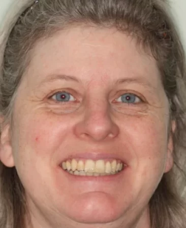 Adult fixed braces sticking out teeth after treatment face Fareham