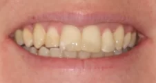 Adult fixed braces sticking out teeth after treatment smile Fareham