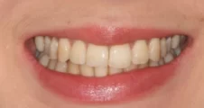 adult patient after invisalign treatment widening dental arch and improving alignment in fareham