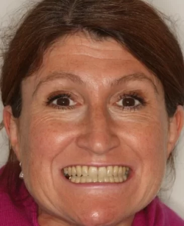 Adult Invisalign narrow smile after treatment with broader smile face Fareham