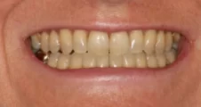 Adult Invisalign narrow smile after treatment with broader smile Fareham
