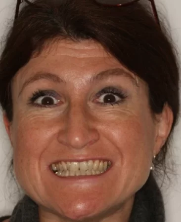 Adult Invisalign narrow smile before treatment Fareham