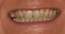 Adult Invisalign narrow smile before treatment smile Fareham