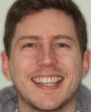 Adult Invisalign crooked teeth after treatment with straightened smile face Fareham