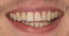 Adult Invisalign crooked teeth after treatment with straightened smile Fareham
