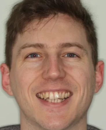 Adult Invisalign crooked teeth before treatment face Fareham
