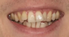 Adult Invisalign crooked teeth before treatment smile Fareham