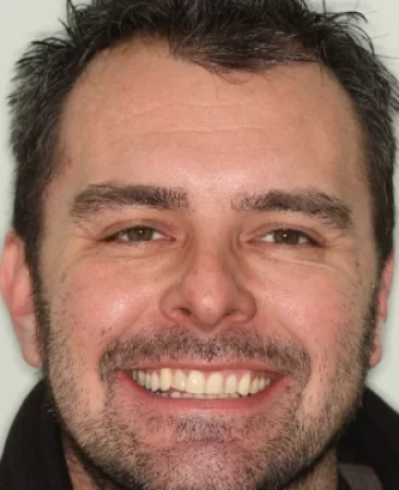 Adult Invisalign crossbite after treatment with corrected bite face Fareham