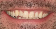 Adult Invisalign crossbite after treatment with corrected bite smile Fareham