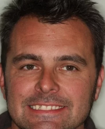 Adult Invisalign crossbite before treatment face Fareham