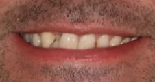 Adult Invisalign crossbite before treatment smile Fareham