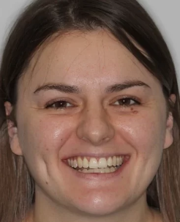 Adult Invisalign crossbite after treatment with corrected bite face Fareham