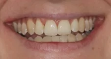 Adult Invisalign crossbite after treatment with corrected bite smile Fareham