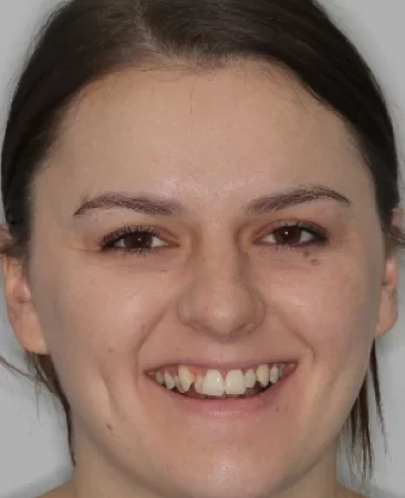 Adult Invisalign crossbite crowded teeth before treatment face Fareham