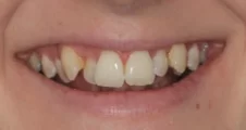 Adult Invisalign crossbite crowded teeth before treatment smile Fareham