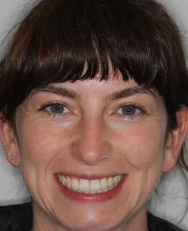 Adult Invisalign crowded teeth after treatment with straightened smile face Fareham